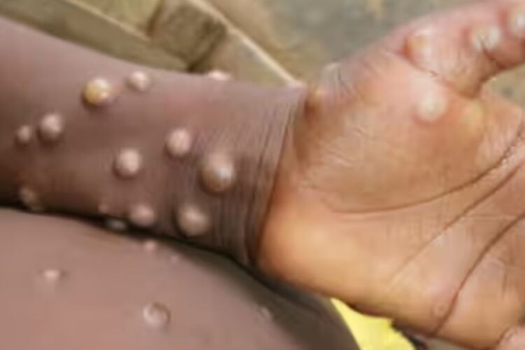 Monkey Pox Case in India