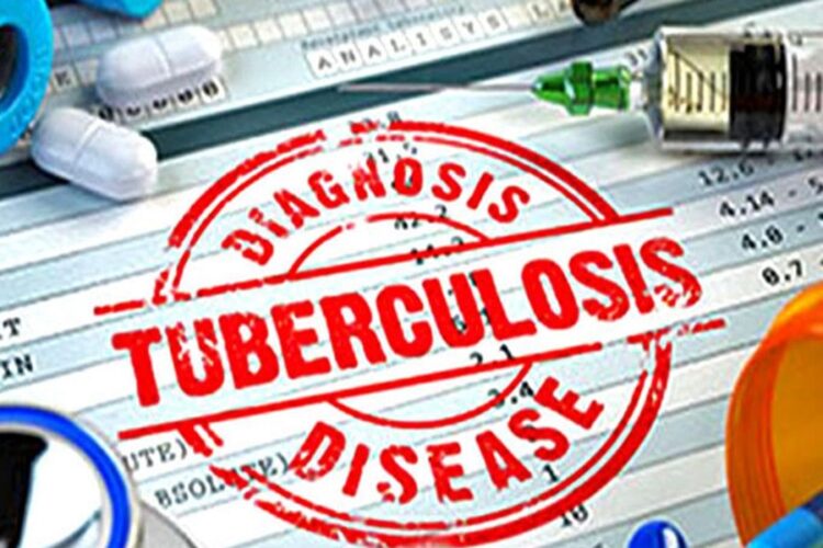 Tuberculosis